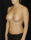 Breast Augmentation and Breast Implants Before and Afters Photos and Pictures 57b