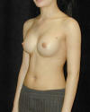 Breast Augmentation and Breast Implants Before and Afters Photos and Pictures 59b