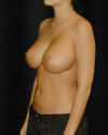 Breast Augmentation and Breast Implants Before and Afters Photos and Pictures 66b