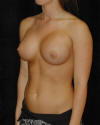 Breast Augmentation and Breast Implants Before and Afters Photos and Pictures 71b