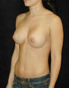 Breast Augmentation and Breast Implants Before and Afters Photos and Pictures 73b