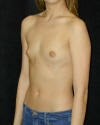 Breast Augmentation and Breast Implants Before and Afters Photos and Pictures 22a