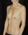 Breast Augmentation and Breast Implants Before and Afters Photos and Pictures 28a