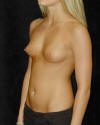 Breast Augmentation and Breast Implants Before and Afters Photos and Pictures 29a