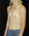 Breast Augmentation and Breast Implants Before and Afters Photos and Pictures 32a