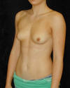 Breast Augmentation and Breast Implants Before and Afters Photos and Pictures 35a