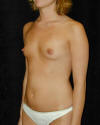 Breast Augmentation and Breast Implants Before and Afters Photos and Pictures 36a