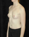 Breast Augmentation and Breast Implants Before and Afters Photos and Pictures 47a