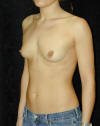 Breast Augmentation and Breast Implants Before and Afters Photos and Pictures 50a