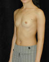Breast Augmentation and Breast Implants Before and Afters Photos and Pictures 59a