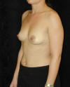 Breast Augmentation and Breast Implants Before and Afters Photos and Pictures 60a