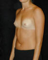 Breast Augmentation and Breast Implants Before and Afters Photos and Pictures 63a