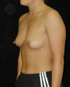 Breast Augmentation and Breast Implants Before and Afters Photos and Pictures 7a