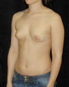 Breast Augmentation and Breast Implants Before and Afters Photos and Pictures 73a