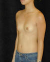 Breast Augmentation and Breast Implants Before and Afters Photos and Pictures 78a