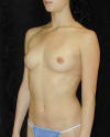 Breast Augmentation and Breast Implants Before and Afters Photos and Pictures 79a