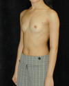 Breast Augmentation and Breast Implants Before and Afters Photos and Pictures 89a